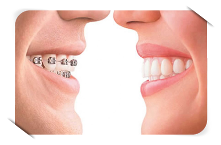 Teeth alignment